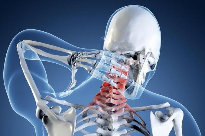 Osteocondrose do 1º grau