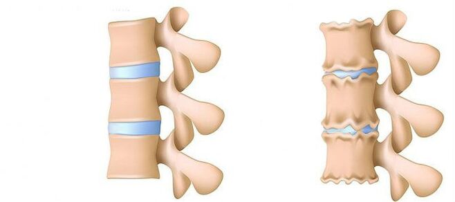 Osteocondrose da região lombar