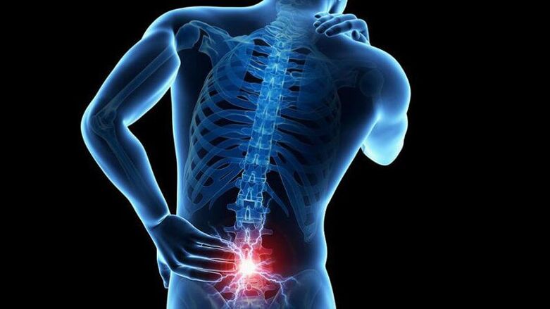 Sintomas de osteocondrose lombar